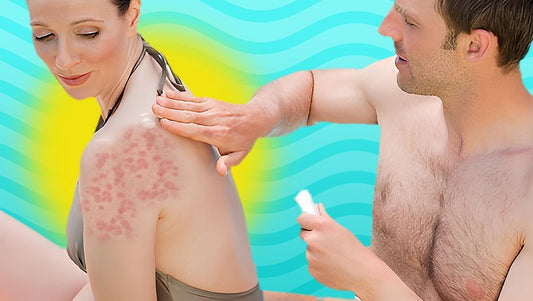 Beat the itch: How to Prevent Chlorine Rashes & itches with Smart Swim Skincare