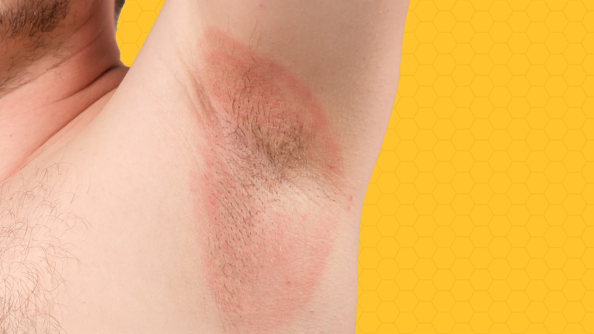 Chafing: Causes, Symptoms, and Effective Remedies – Elemnt